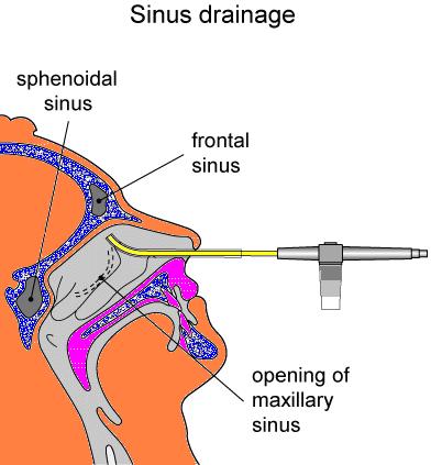 sinus_drainage